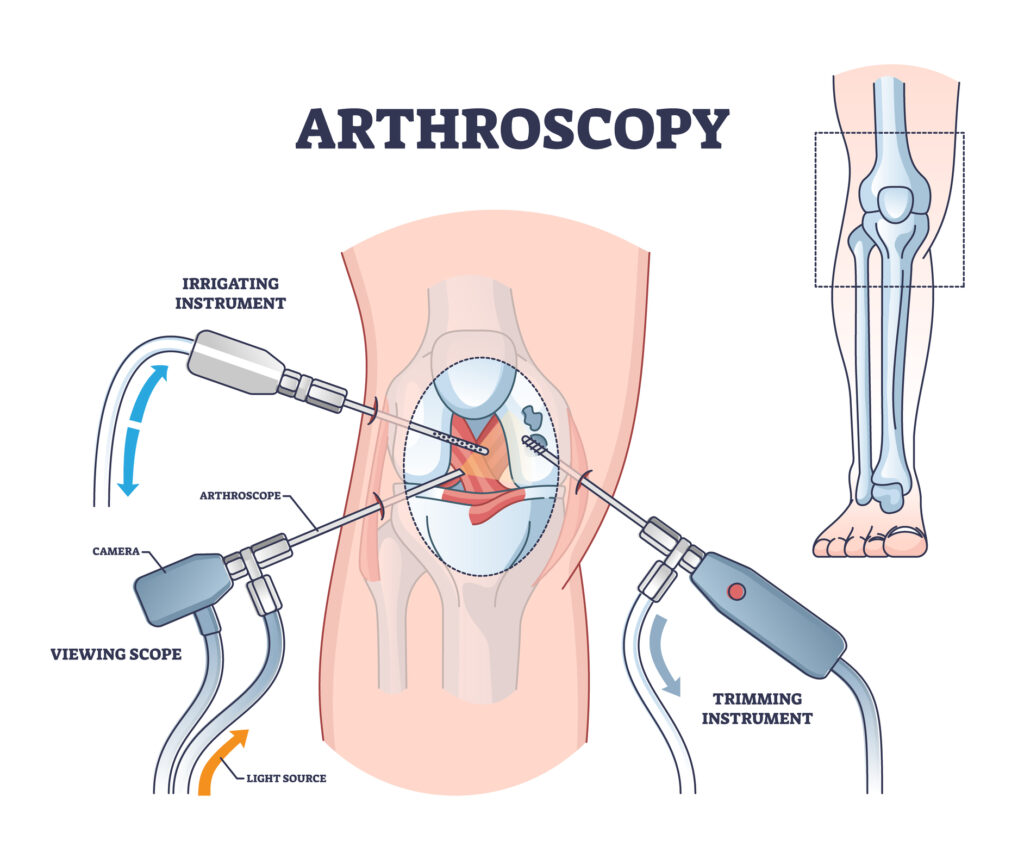 Arthroscopy procedure as knee diagnostics process explanation outline diagram