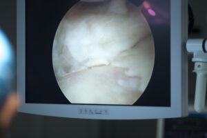 Arthroscopy: What to Know, How It Works, & Possible Risks￼
